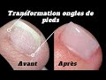 Transformation dongles  correction ongles de pieds  pdicure cosmtique  roses on the nails