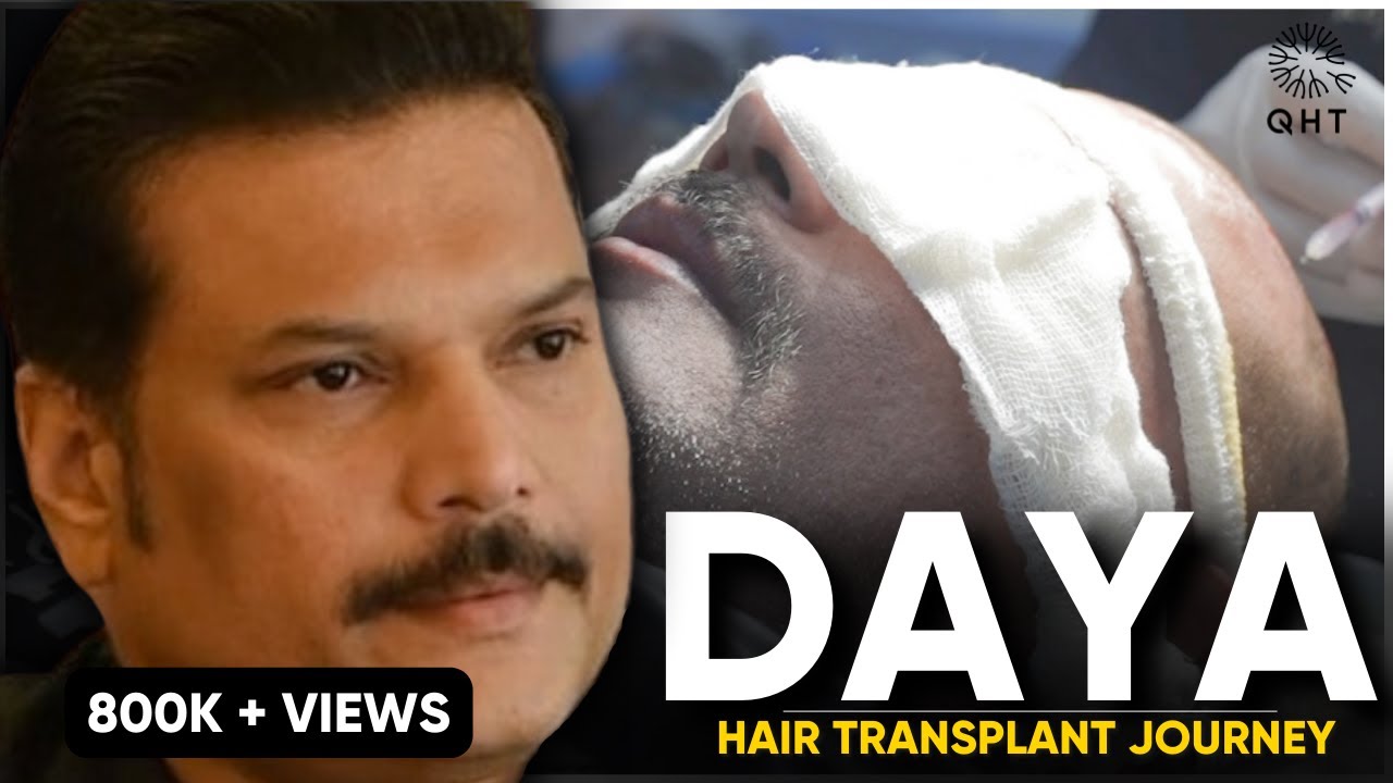 Best Hair Transplant Clinic in Roorkee Haridwar and Dehradun