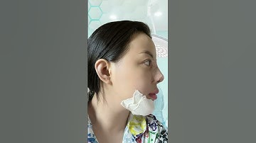 Đây là tôi sau 12 ngày nâng mũi, độn cằm #nangmui #doncam #minhon