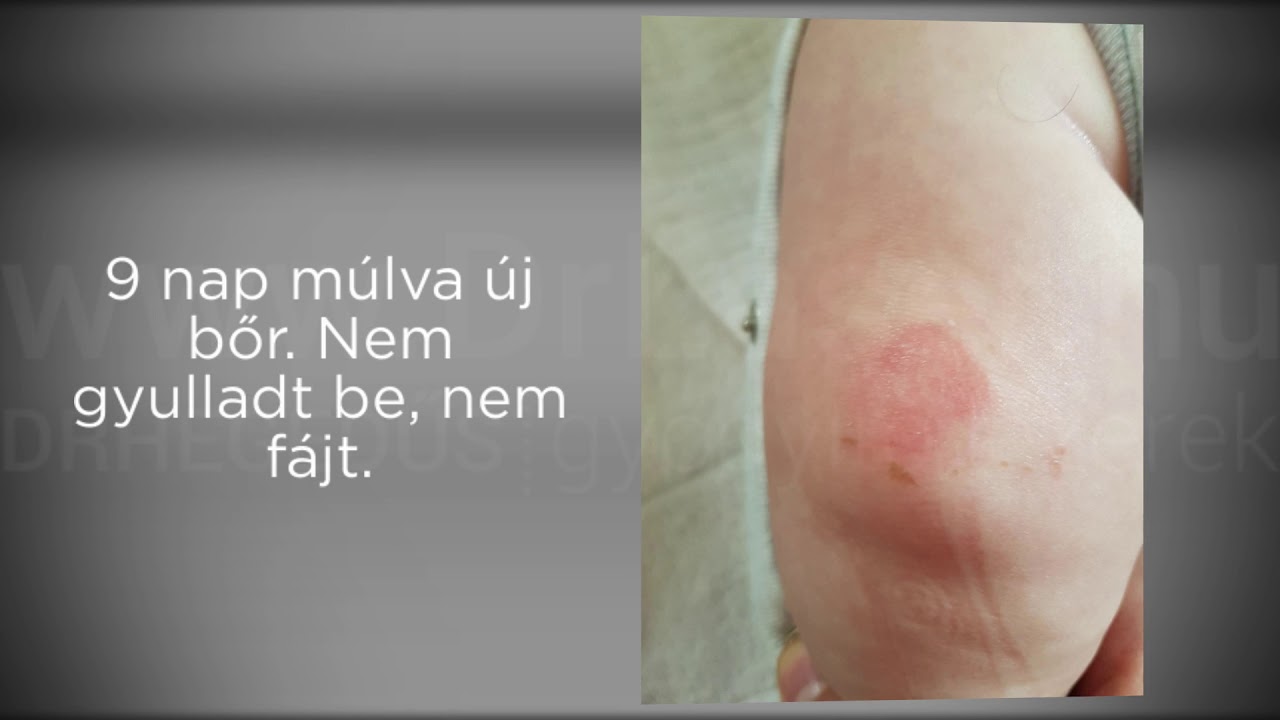 Psoriasis kezelés - A kontakt pikkelysömör kezelésében