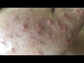 Acne Treament Under The Skin #063