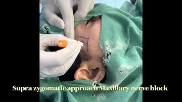 Maxillary nerve block by supra zygomatic approach