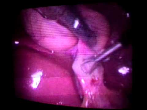 lap chole(callots triangle dissection difficult)
