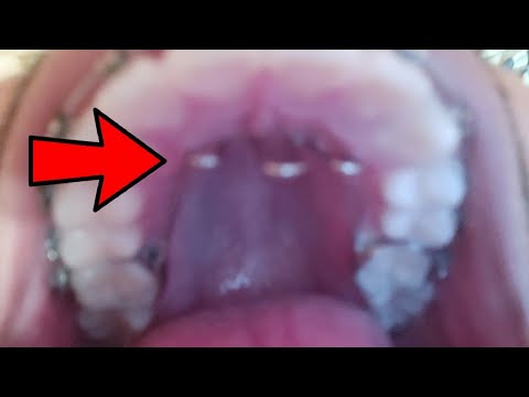 Rejilla lingual |Trampa