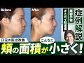 口ゴボ改善だけじゃない！顔全体のバランスを整える手術とは【両顎手術＋オトガイ形成術】
