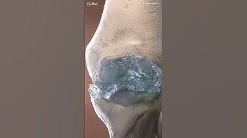 3DforScience Osteoarthritis video