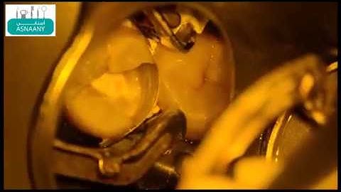 Deep Marginal Elevation (pre-endodontic build-up)  (Asnaany)