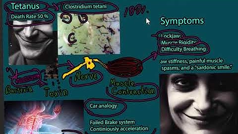 Tetanus Disease (Lockjaw)  - signs and symptoms, prevention,  treatment and prognosis