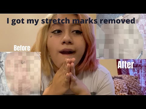 Video: Kos Penyingkiran Laser Stretch Mark