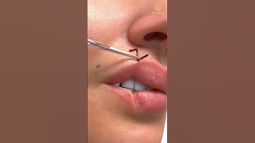 Z-Plasty & V-Y Advancement Animation | Reconstructive Plastic Surgery for Scars & Lip Repair