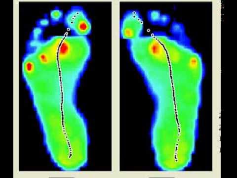 Podobarometría de un pie plano valgo - YouTube