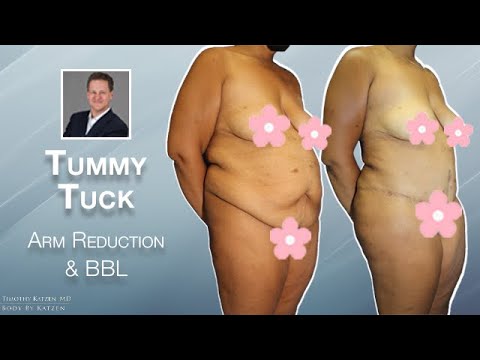 BBL Brazilian Buttock Lift plus a Tummy Tuck  + Arm Reduction
