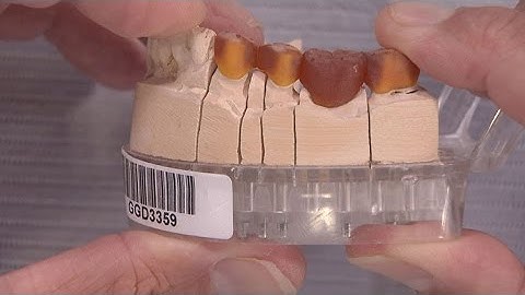 Case of the week: Examining Undercuts in a Bridge Impression