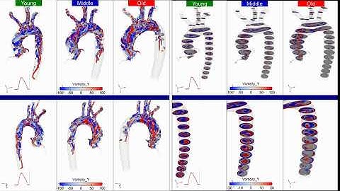 CFD Simulation of an Aorta at Different Ages