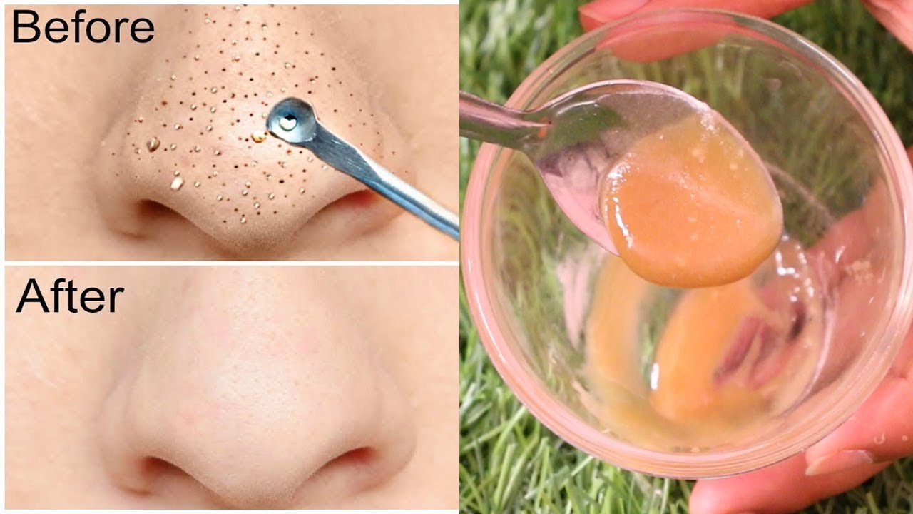 first-time-using-baking-soda-to-remove-blackheads-whiteheads-from