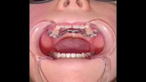 How to Complete an Incomplete/ Stuck Expander Turn- Pediatric Dentistry & Family Orthodontics