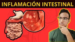 5 COSAS QUE TE INFLAMAN EL INTESTINO: Síndrome de Intestino Irritable