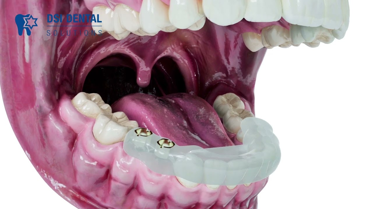 Achieving an accurate implant placement without direct bone visualisation --patented Implight tool