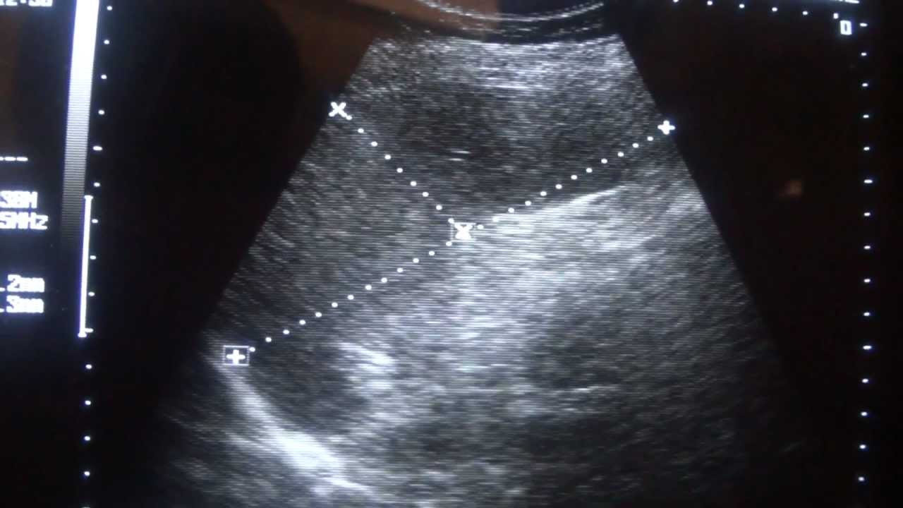 Enlarged Spleen Ultrasound