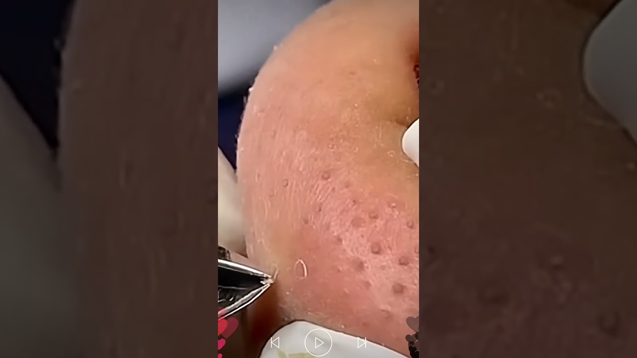 Skincare | Blackheads Removal #404 #tweezers skincare #blackheads blackheads