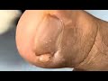 Ep_6603 Ingrown toenail removal 👣 เนื้อปูดแบบนี้ เกิดได้ยังไงครับ 😄 (clip from Thailand)