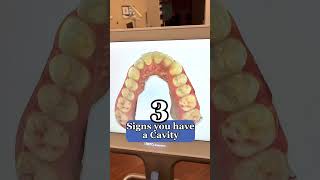 3 signs you have a cavity‼️ #shorts