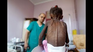 Yemen'de her 10 dakikada 1 çocuk ölüyor! Resimi