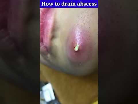 Video: Hur bli av med en abscess: 12 steg (med bilder)