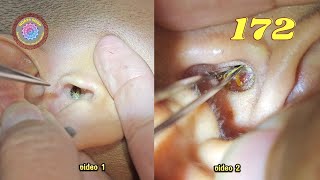 Professional Earwax Removal. Episode 172