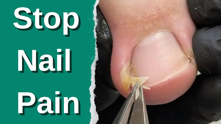 Painful Ingrown Toenail? Watch How I Fixed a Doctor’s Nail