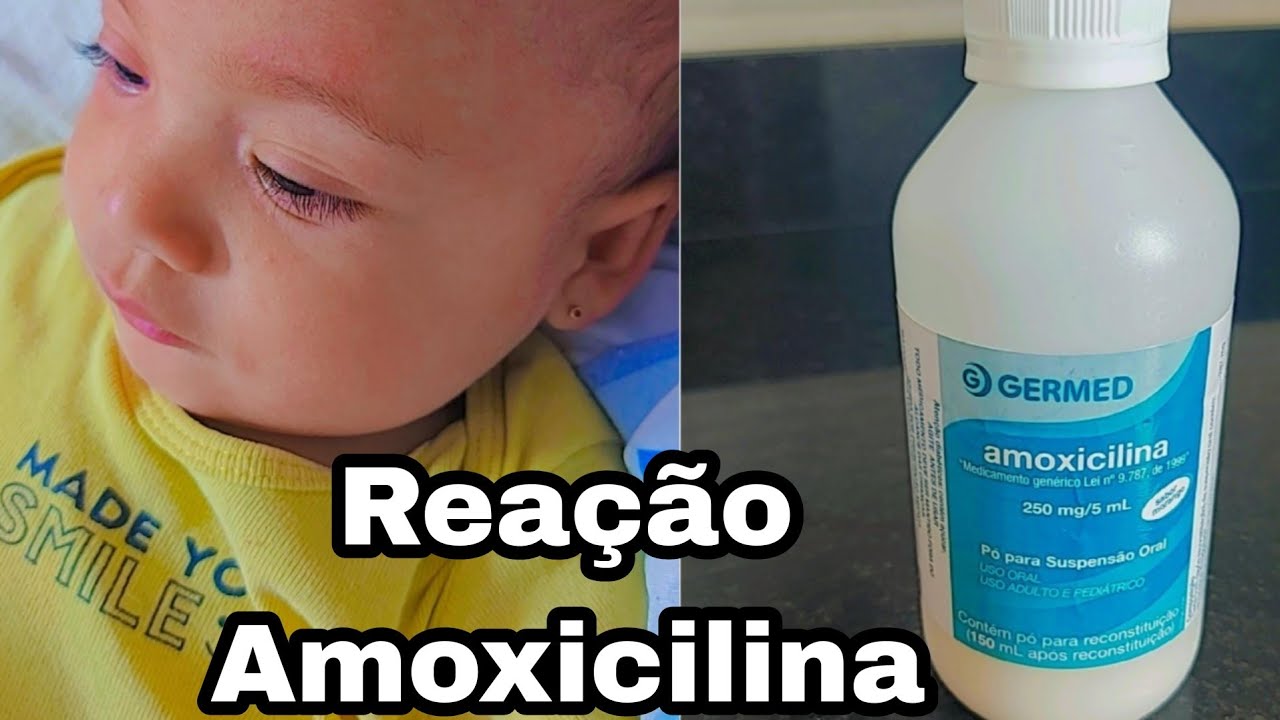 Reação a Amoxicilina? - YouTube