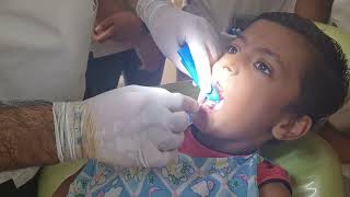 Rubber Dam placement in pediatric patient