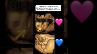 Jenis Kelamin Saat Usg Kelihatan Sangat Jelas Sekali