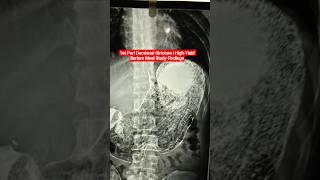 1st Part Duodenal Stricture | High-Yield Barium Meal Study Findings #medicosfactz #medicaleducation