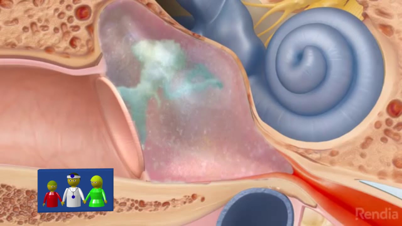 Diferencia entre otitis externa, media e interna   Dr  Tristan Carignani   15 2 2020