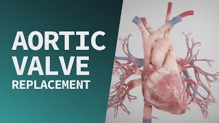 Aortic Valve Replacement