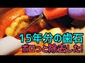 Remove Tartar! 15年分の歯石をボロっと除去しました！