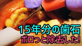 Remove Tartar! 15年分の歯石をボロっと除去しました！