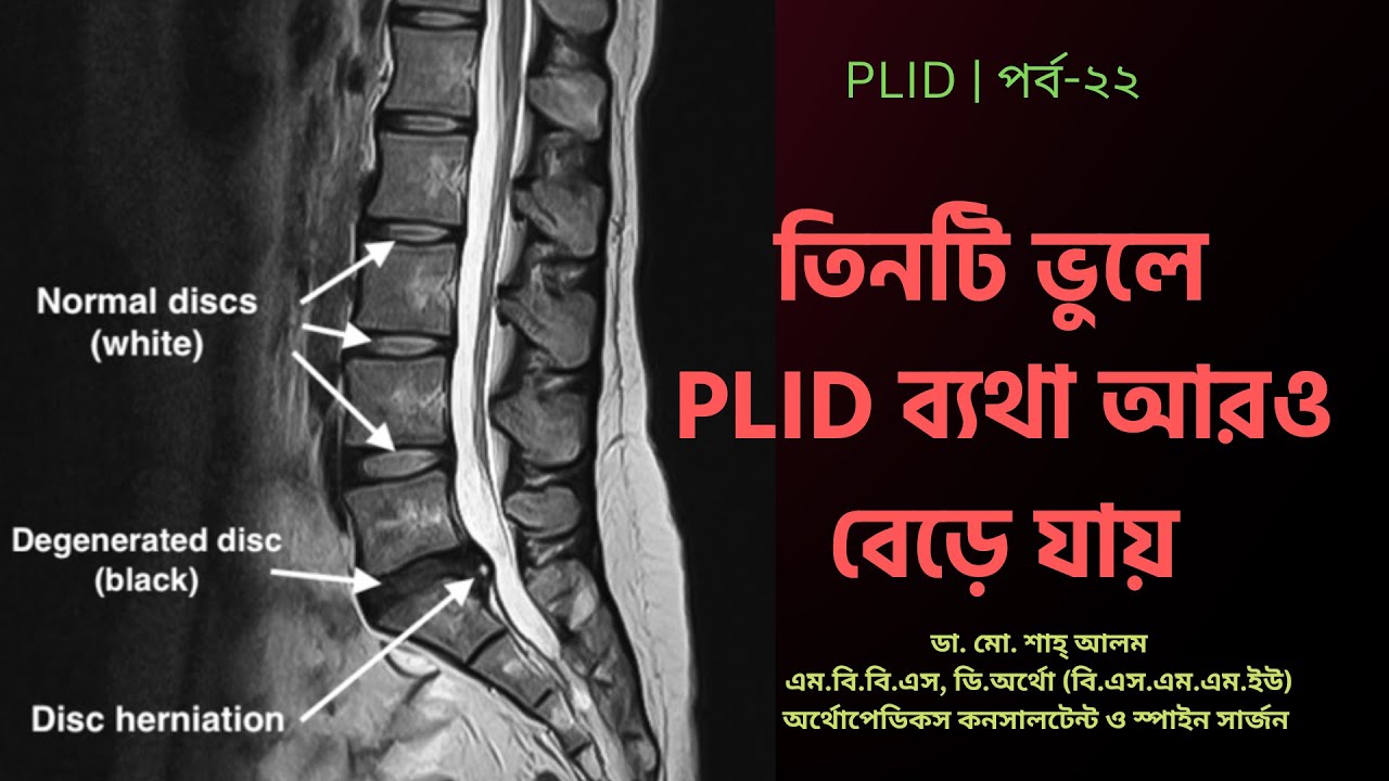 PLID 22 | তিনটি ভুলে PLID ব্যথা আরও বেড়ে যায় | 3 Mistakes More PLID Pain | Doctor Shah Alam
