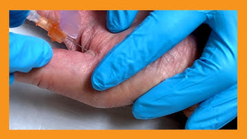 Trigger Thumb Injection with Dr. Gawayne | Auburn Medical Group