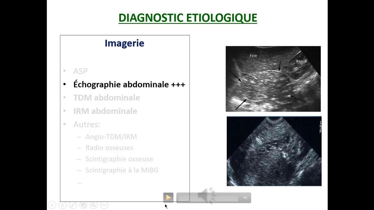 Tumeurs abdominales de l'enfant - Comité Pédagogique de pédiatrie : Docteur N.ALIM