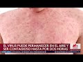 Confirman un nuevo caso de sarampión en el condado Dallas: la persona afectada visitó estos lugares