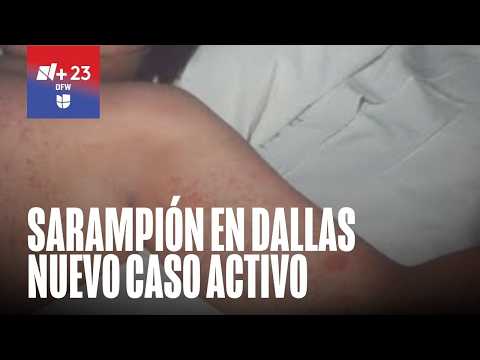 Confirman un nuevo caso de sarampión en el condado Dallas: la persona afectada visitó estos lugares