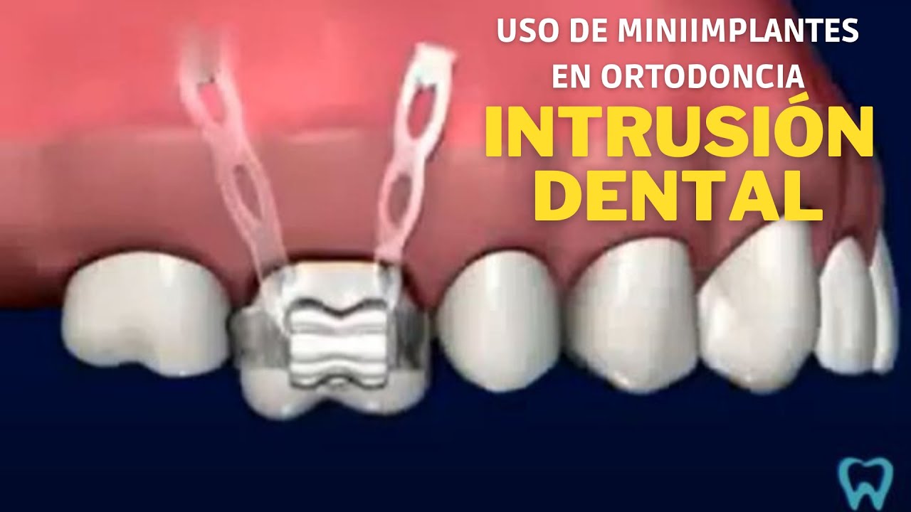 INTRUSIÓN DENTAL con el uso de miniimplantes en Ortodoncia YouTube