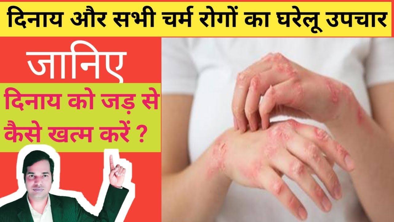 dinay ko kaise theek karen I dinay ko jad se kaise khatam karen I dinay