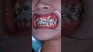 Amazing braces. From super crooked teeth to perfect smile #braces #dentist #orthodontics #smile