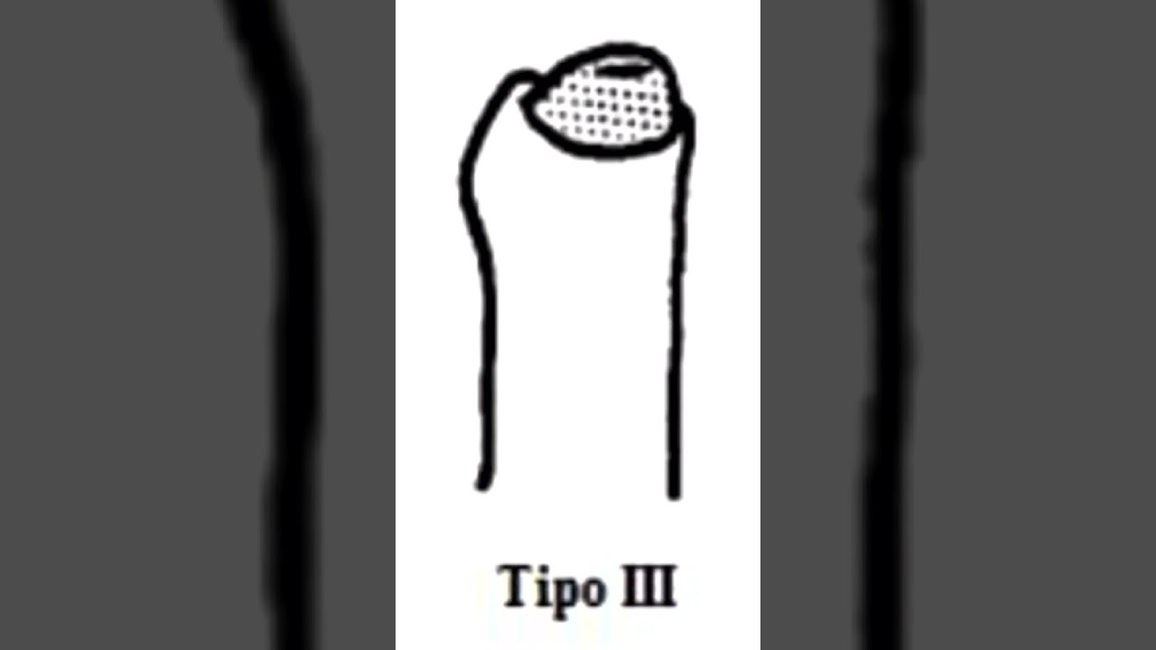 As classificações da fimose. Quer saber mais sobre? Assista ao vídeo na íntegra! #urologista #fimose