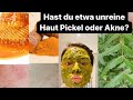 Hast du unreine haut hast du pickel oder akne