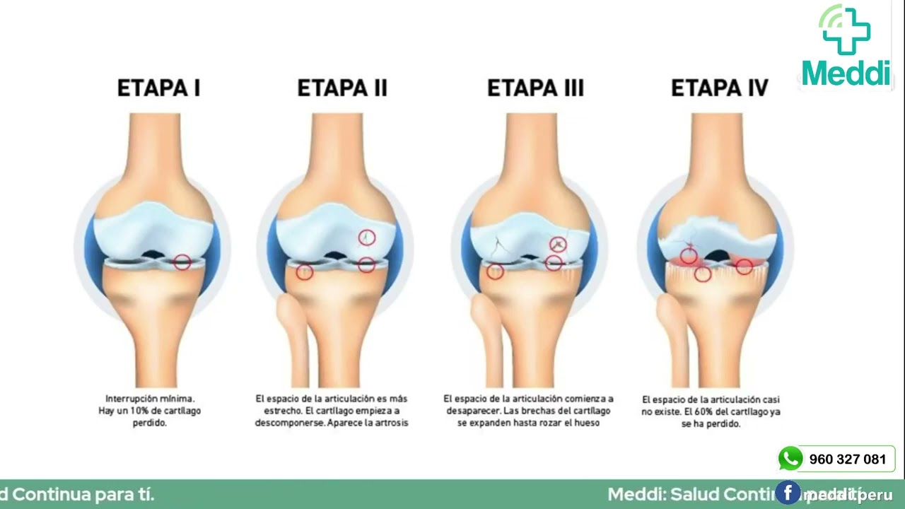Artrosis y Osteoartritis.