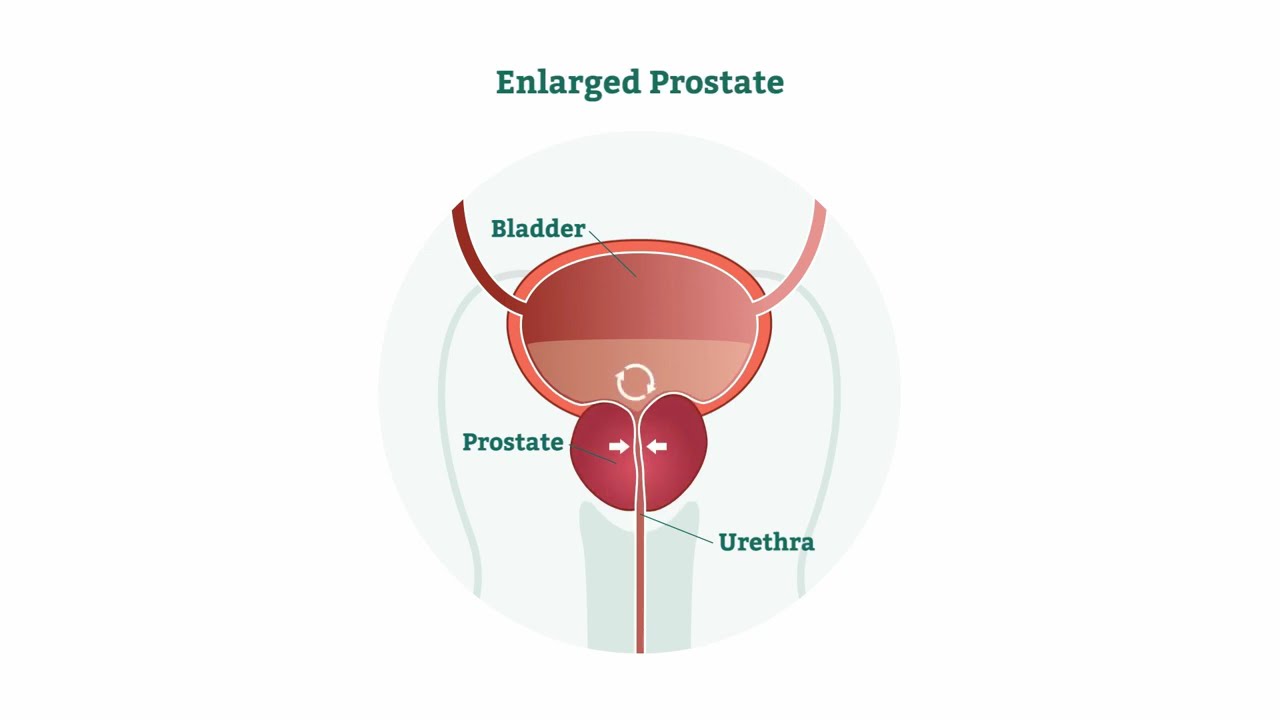 Optilume for BPH Education Video 2